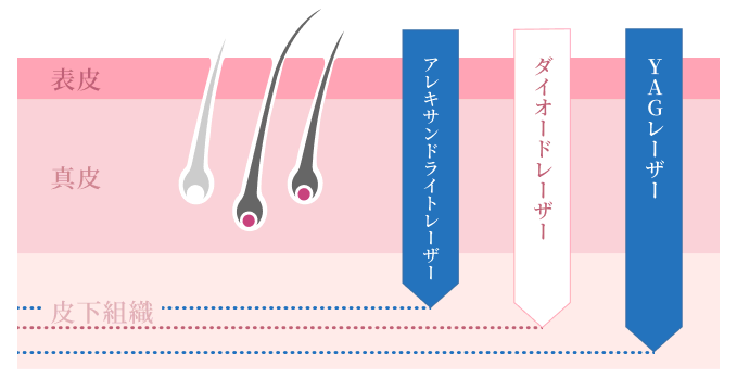 お客様の肌質・毛質に合わせたレーザーで施術