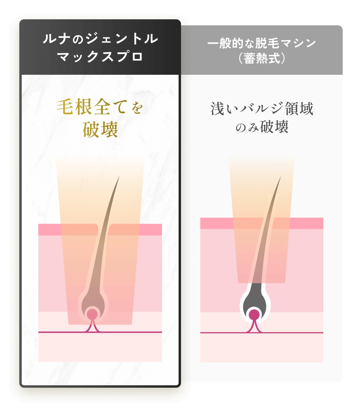 ルナのジェントルマックスプロは毛根全てを破壊。一般的な脱毛マシン（蓄熱式）は浅いバルジ領域のみ破壊