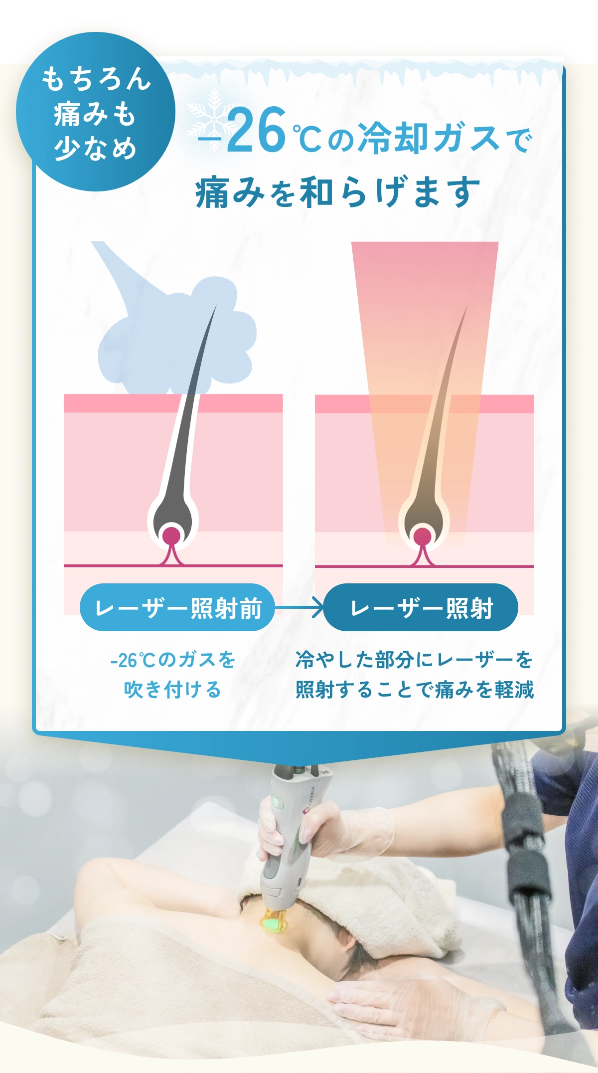 もちろん痛みも少なめ。−26℃の冷却ガスで痛みを和らげます。レーザー照射前に-26℃のガスを吹き付け、冷やした部分にレーザーを照射することで痛みを軽減