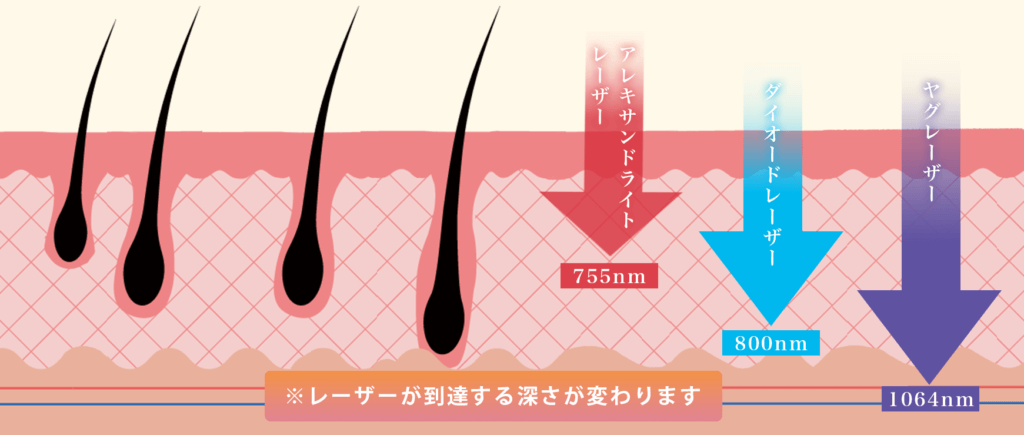 医療脱毛のレーザーごとの痛み