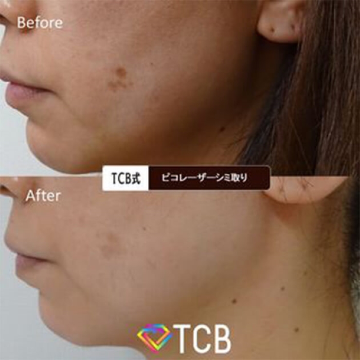 TCBのシミ取りの症例