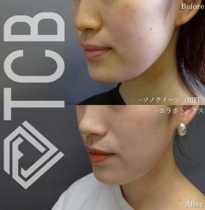 TCBのハイフ症例