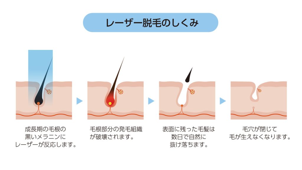 医療脱毛の効果