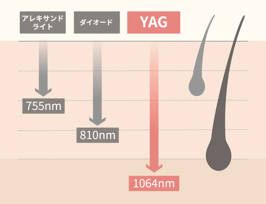 レーザーの種類