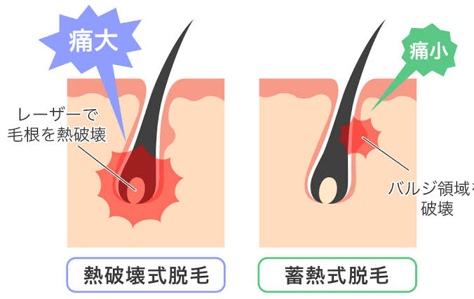 医療脱毛の照射方法ごとの痛み