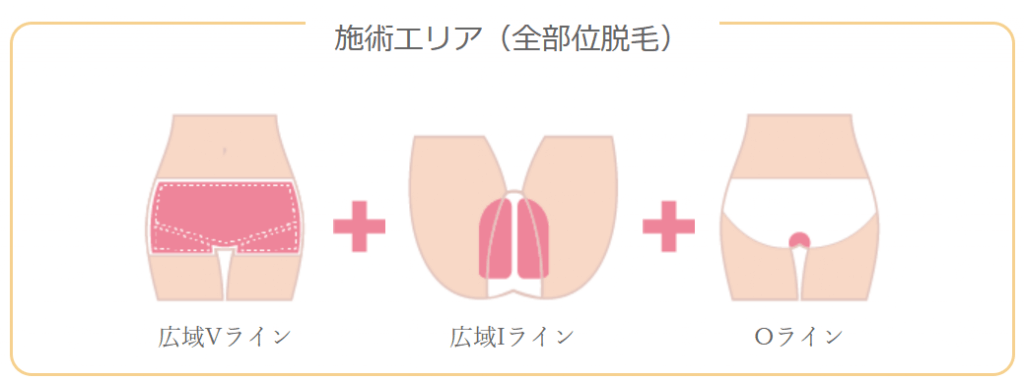 プリートのVIO脱毛の施術範囲