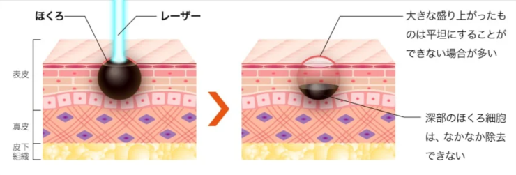 ほくろ除去のレーザー治療