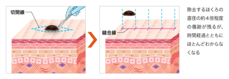 ほくろ除去の切除手術