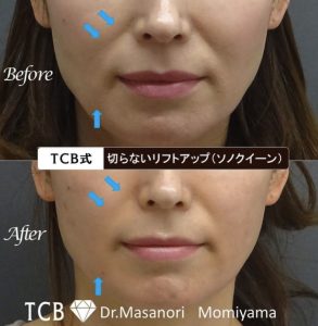 TCBのハイフ症例
