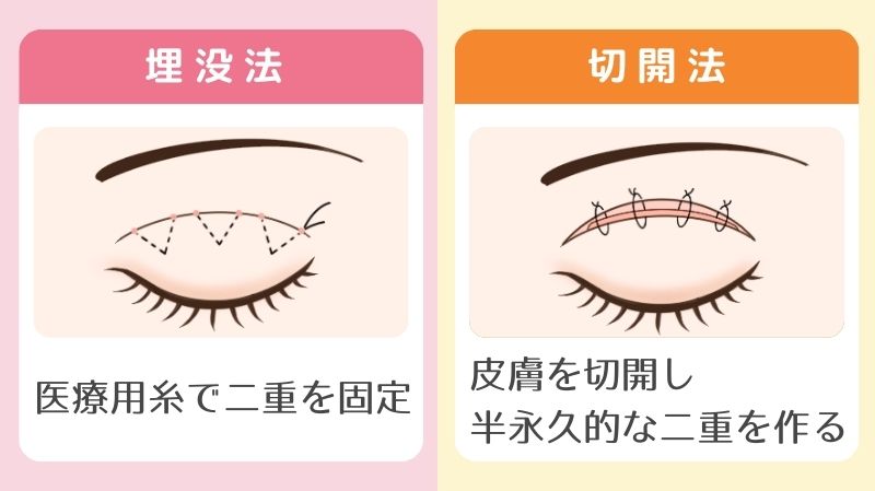 埋没法と切開法を比較