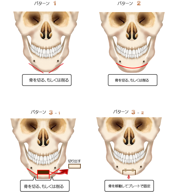 骨切り・エラ削り