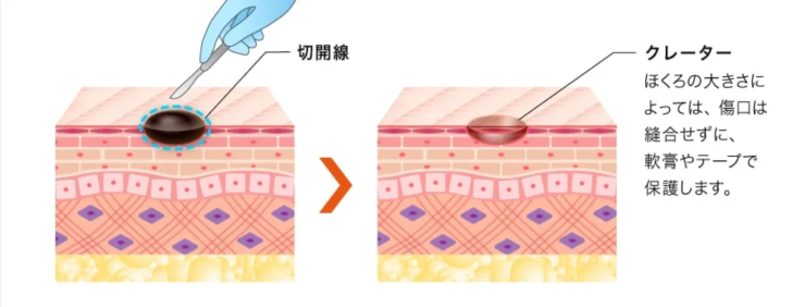 ほくろ除去のくり抜き法