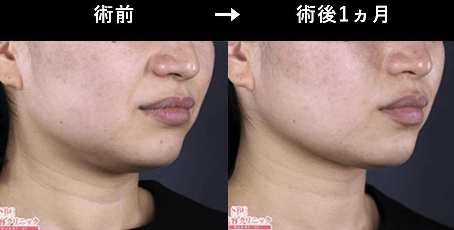 湘南美容クリニックのハイフ症例