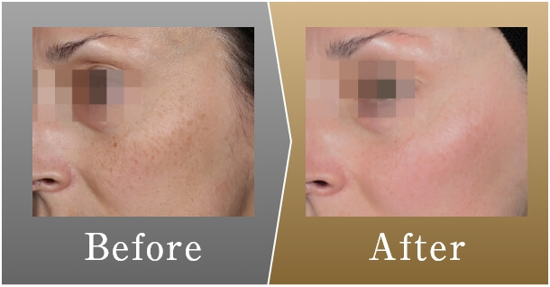 Before After