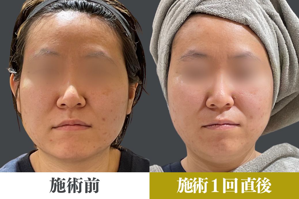 HIFUでお手軽リフトアップ - 【公式】ルナビューティークリニック